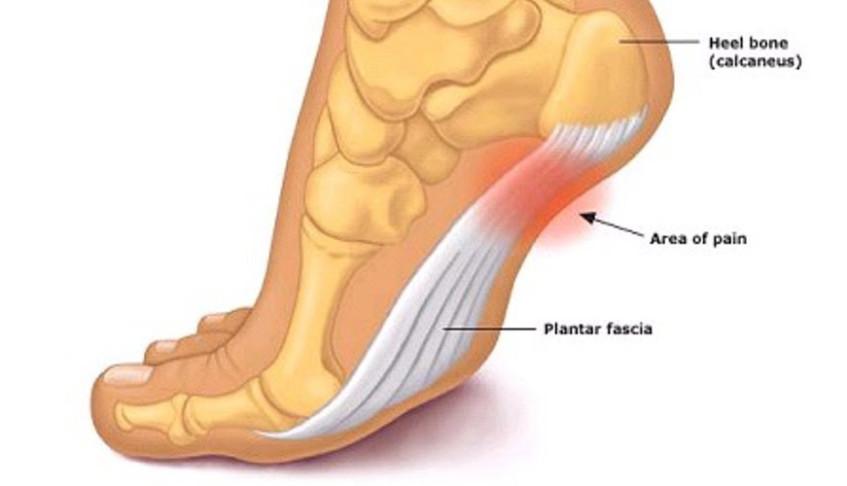 foot fascia tear