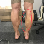 calf strain in a runner