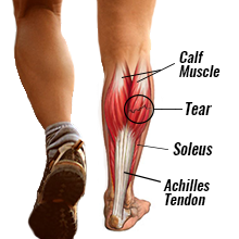 Calf Strains: Causes, Symptoms And Treatment - AIRROSTI