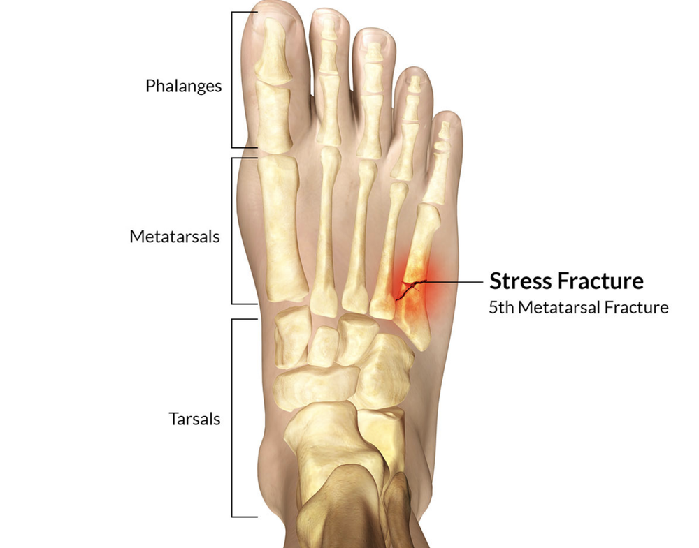 running stress fracture shin